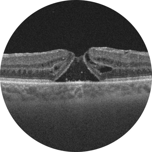 Trou maculaire