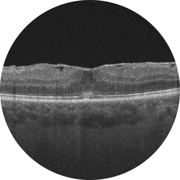 Membrane épirétinienne