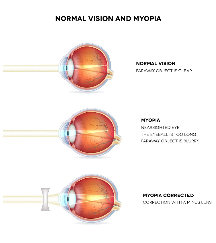 Qu’est-ce que la myopie ?